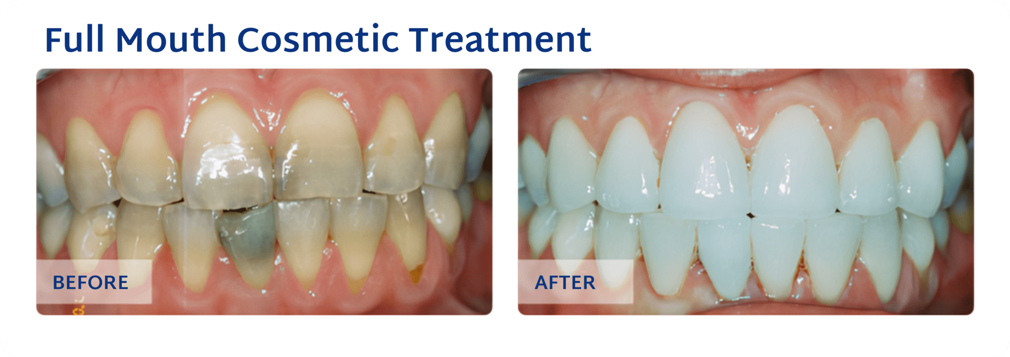 Full Mouth Cosmetic Treatment