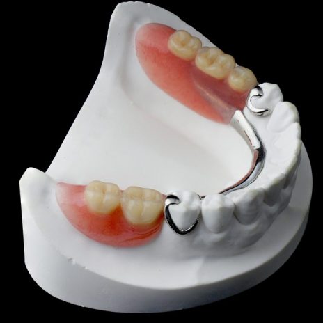 Partial-Dentures